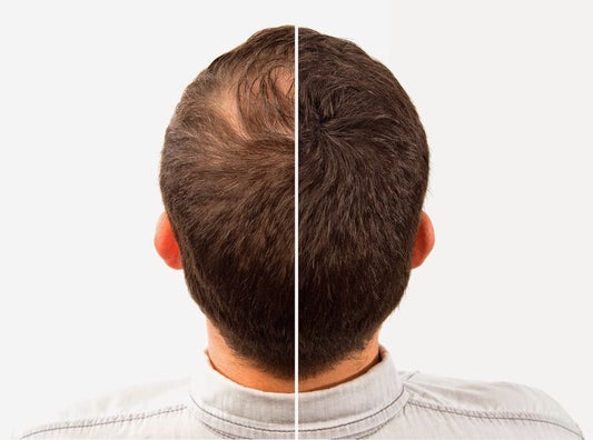 Tratamiento Capilar 10 Sesiones