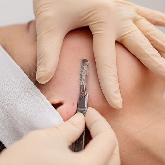 Dermaplaning + Depilación láser