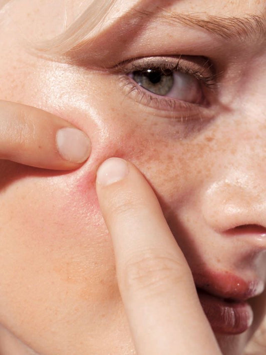 Facial Anti Acne